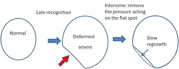Plagiocephaly - image to show deformed head - motherhooddiaries