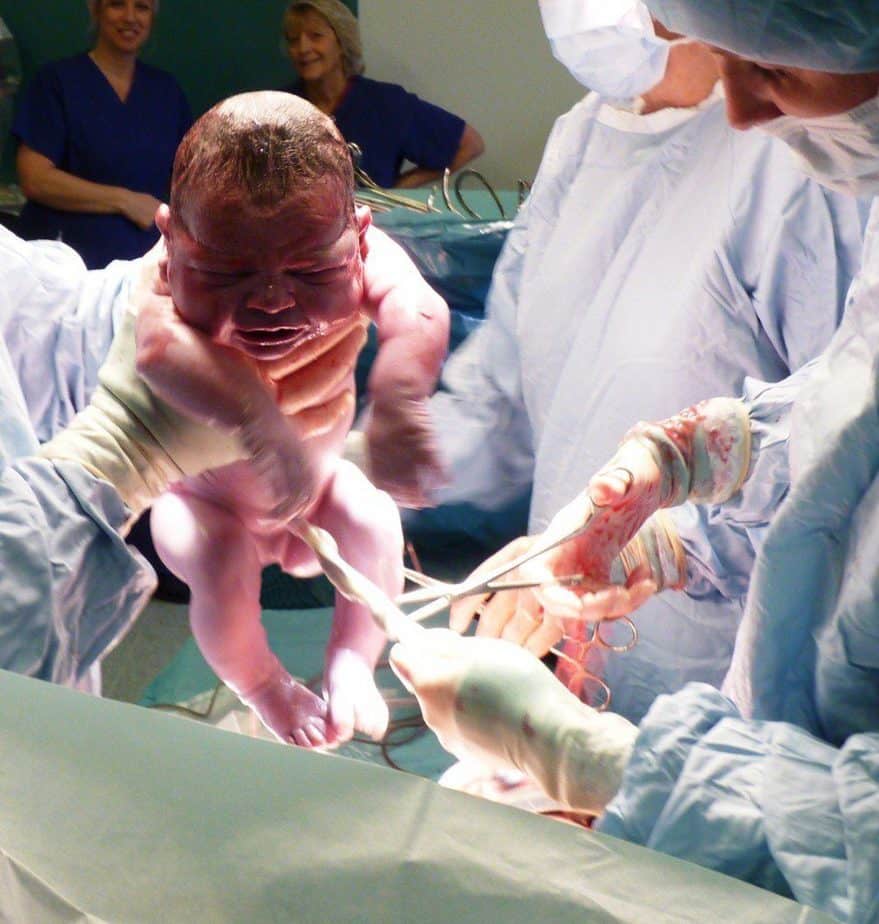 My thoughts on caesarean section