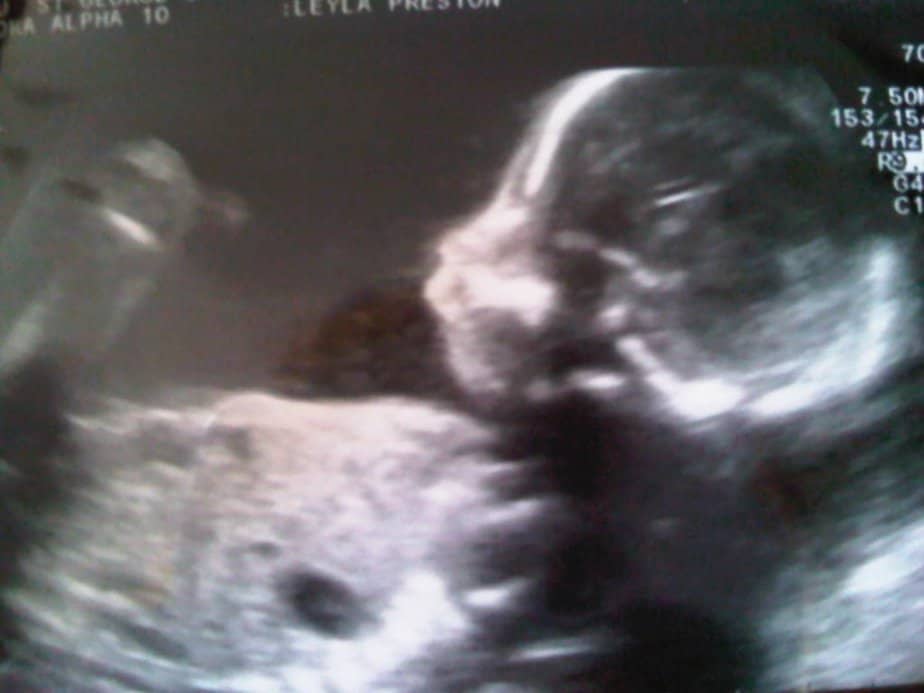 Our baby boxer at 20 weeks