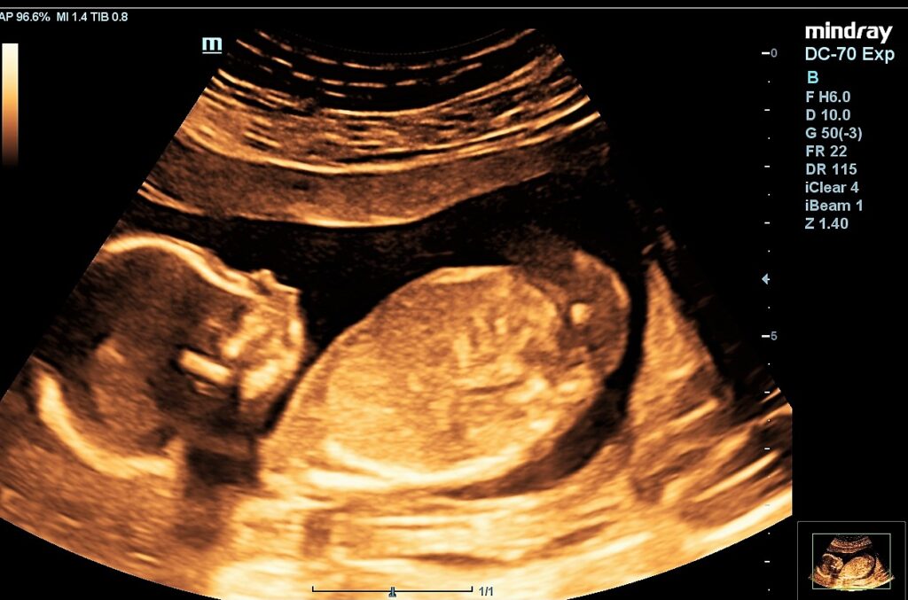 17 week wellbeing scan