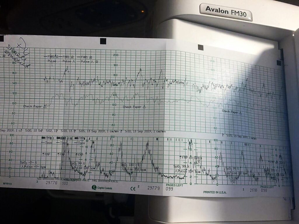 Monitoring regular contractions