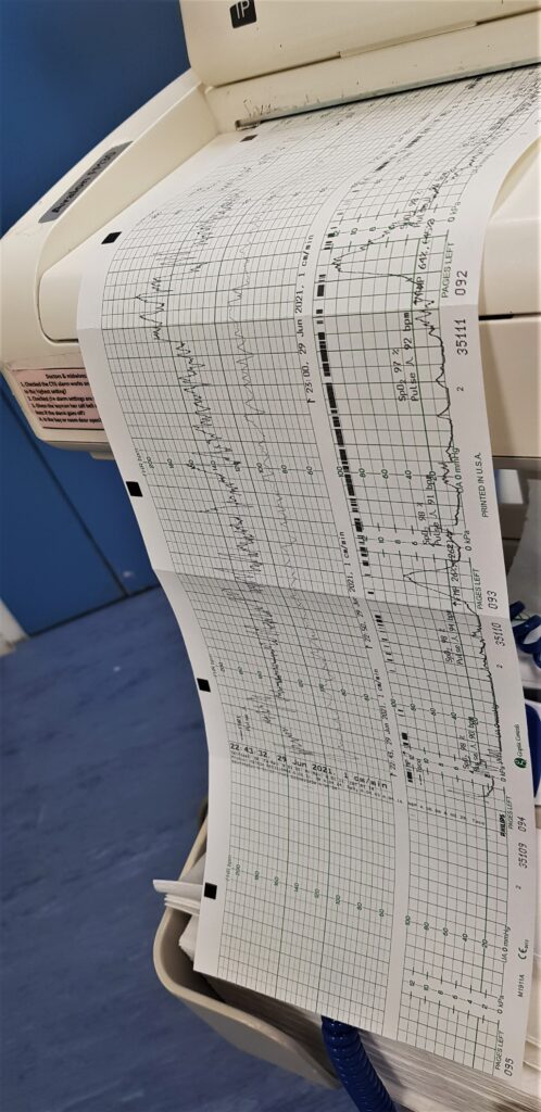 Irregular contractions - has labour started?