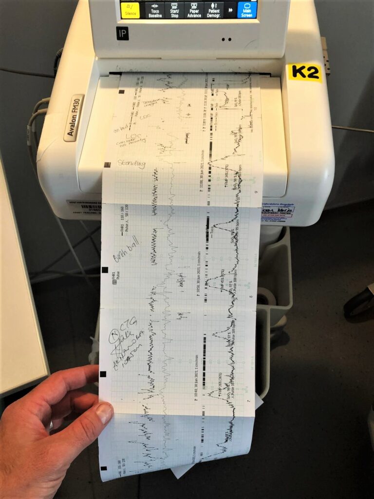 Regular contractions have started! VBAC story