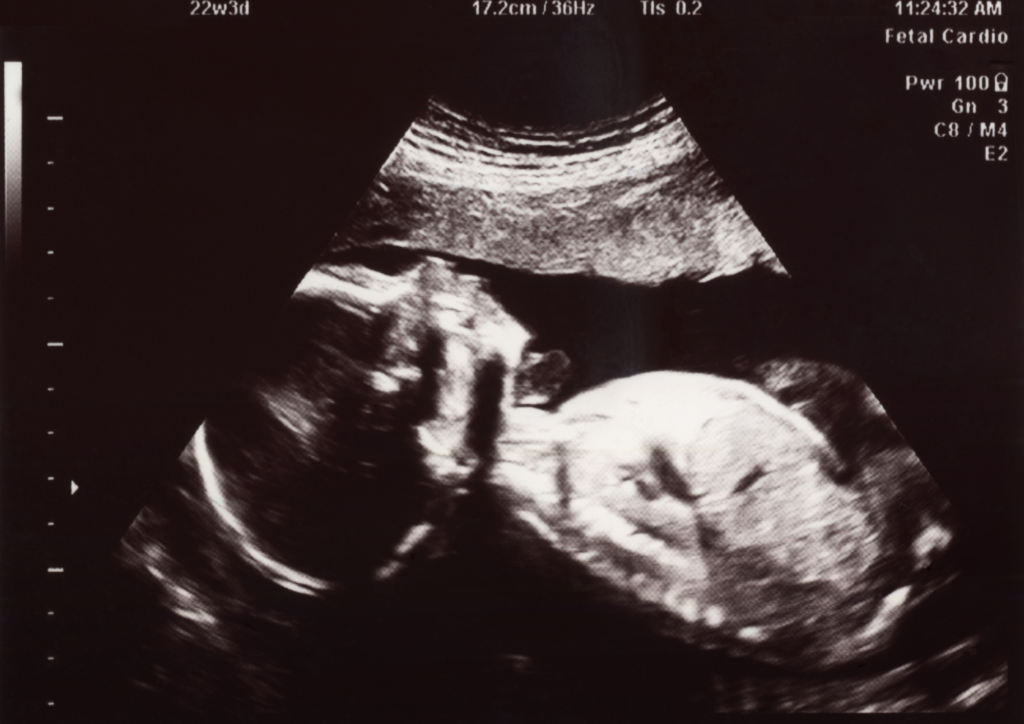 22 weeks pregnant ultrasound