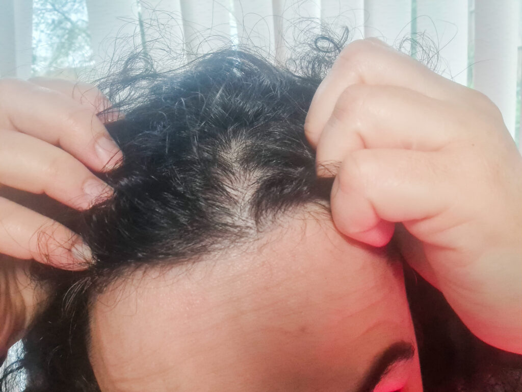 Postpartum thinning - red light therapy for hair loss