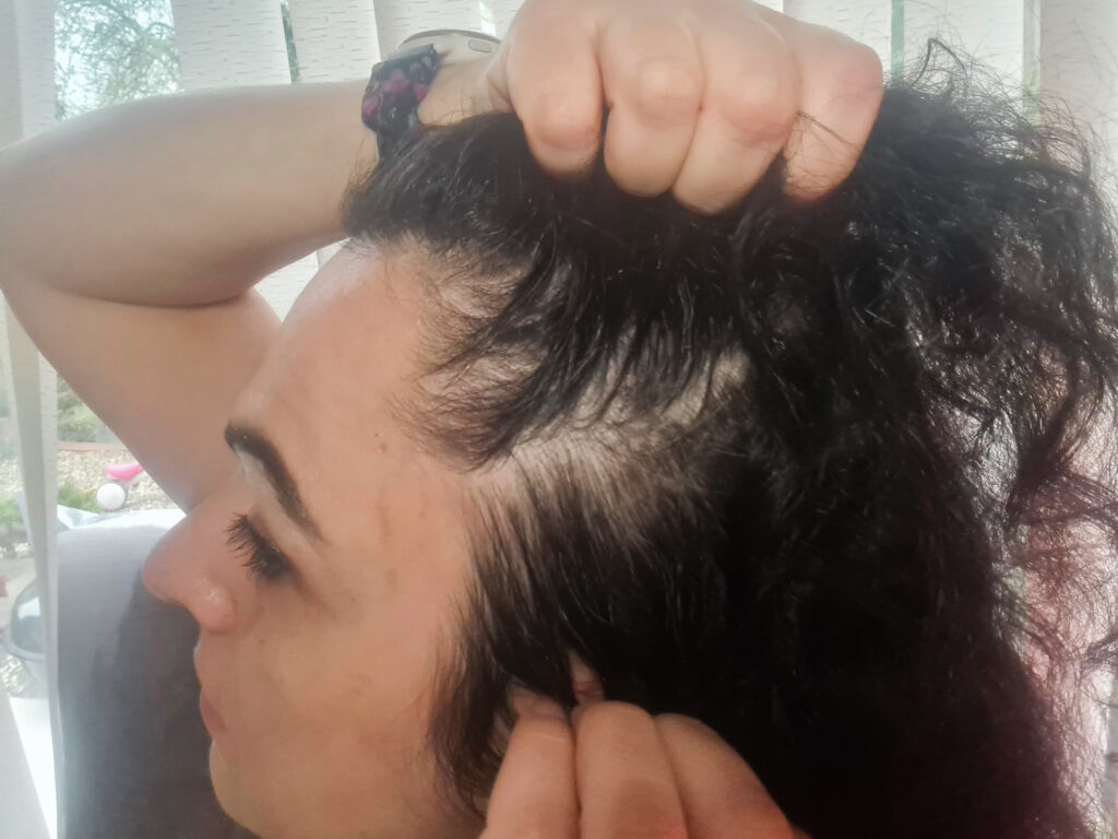 Postpartum thinning - red light therapy for hair loss