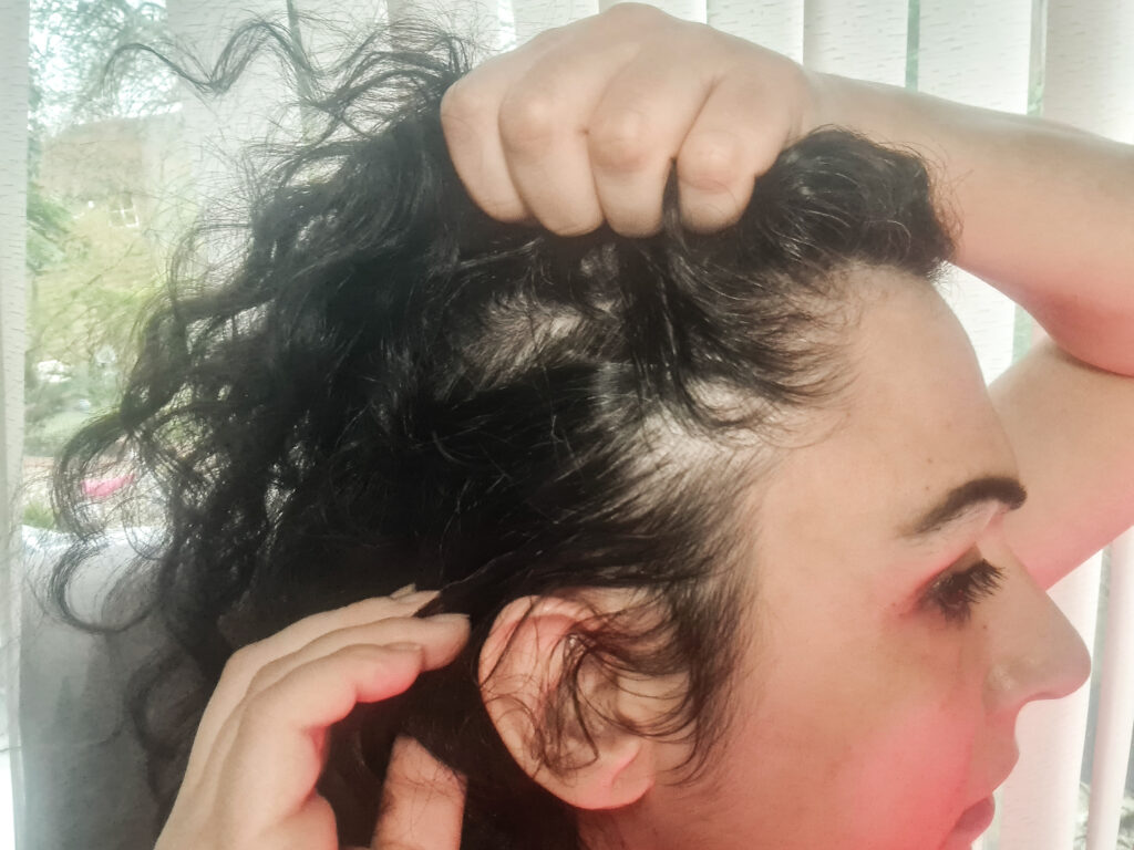 Postpartum thinning - red light therapy for hair loss