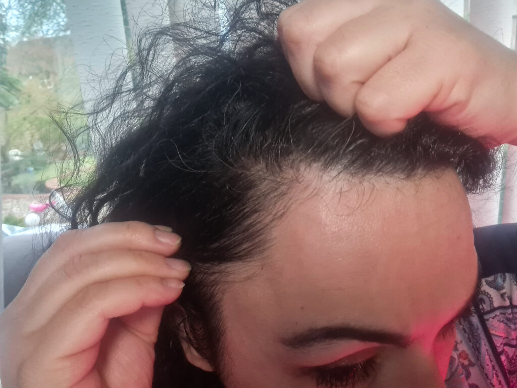 Postpartum thinning - red light therapy for hair loss